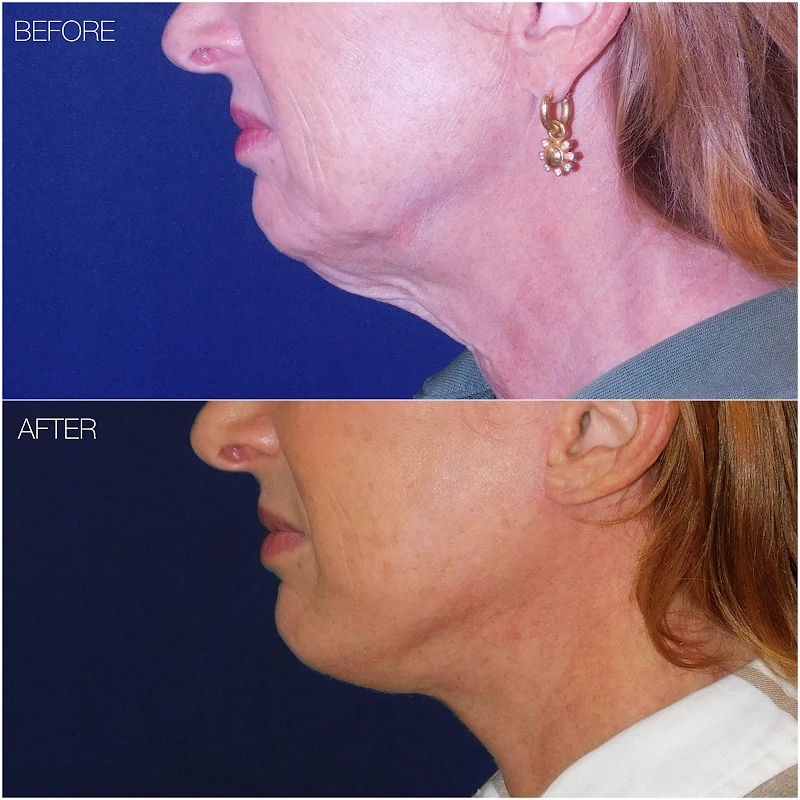 Washingtonian Plastic Surgery, Mclean, Virginia, 22102