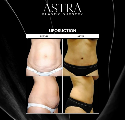 astra-plastic-surgery-atlanta-4.png