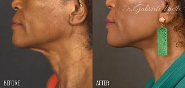 me-plastic-surgery-dr-gabriele-miotto-3.png