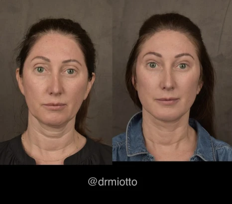 me-plastic-surgery-dr-gabriele-miotto-4.jpg