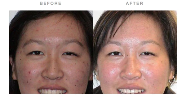 skinzone-laser-cosmetic-surgery-dr-hannah-vu-md-4.png