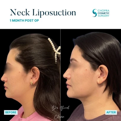 vinod-k-chopra-md-chopra-cosmetic-surgery-1.jpg