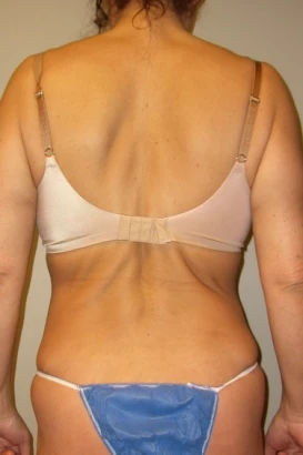 image-by-design-plastic-surgery-plastic-surgeon-breast-augmentation-michigan-1.jpg