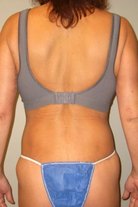 image-by-design-plastic-surgery-plastic-surgeon-breast-augmentation-michigan-4.jpg