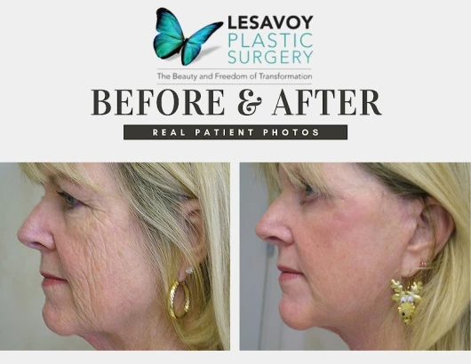 lesavoy-plastic-surgery-3.jpg
