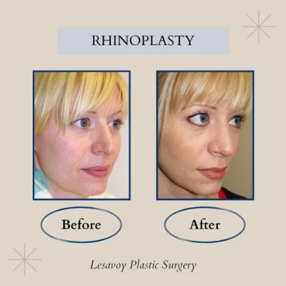 lesavoy-plastic-surgery-4.png