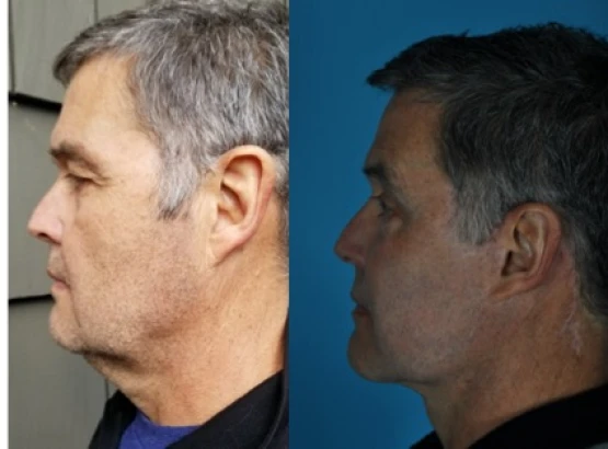 totonchi-plastic-surgery-2.jpg