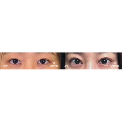 wave-plastic-surgery-aesthetic-laser-center-san-francisco-4.jpg