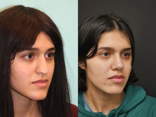 rhinoplasty-surgery-maryland-4.jpg