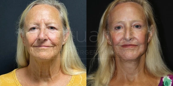 renuance-cosmetic-surgery-medspa-rancho-bernardo-4.jpg